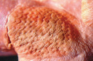 Trong một số trường hợp, các vùng da tổn thương khá nổi bật do nhiễm bệnh Ecoli trên gà.