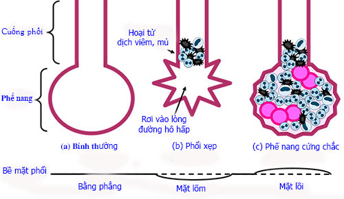 Hình 1: Những biến đổi của nang phổi