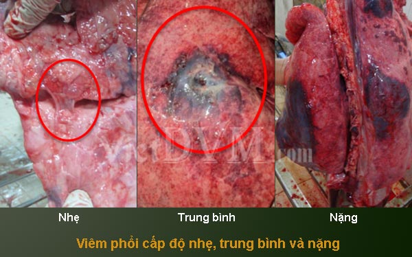 Viêm phổi cấp độ nhẹ, trung bình và nặng