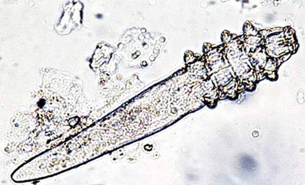 Mò bao lông Demodex qua kính hiển vi
