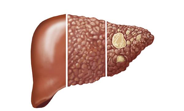 Chất độc trong gan nếu không được đào thải hết sẽ gây khối u (Hình minh họa)