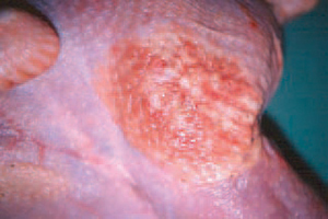 Viêm mô tế bào – vùng da viêm chủ yếu ở lưng và đùi.