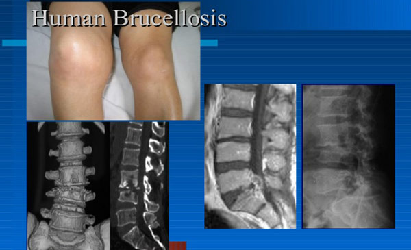 Bệnh có thể lây lan và gây ảnh hưởng nghiêm trọng lên người.