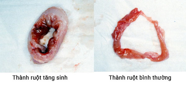 Thành ruột viêm tăng sinh dày hơn so với bình thường khá nhiều.