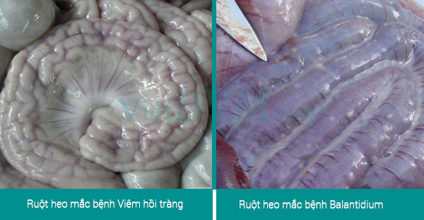 Biểu hiện trên ruột rất điển hình của 2 bệnh